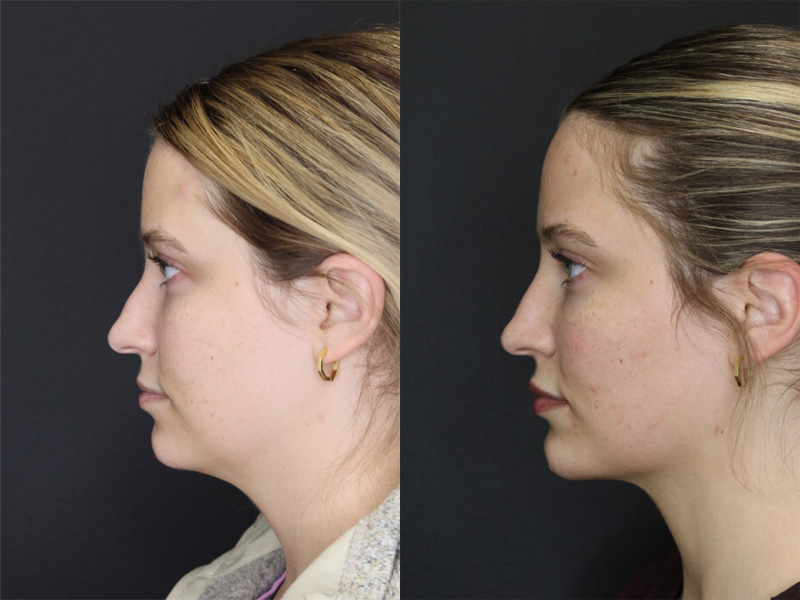 Before and After Plastic Surgery Results | Raggio MD Birmingham, Al