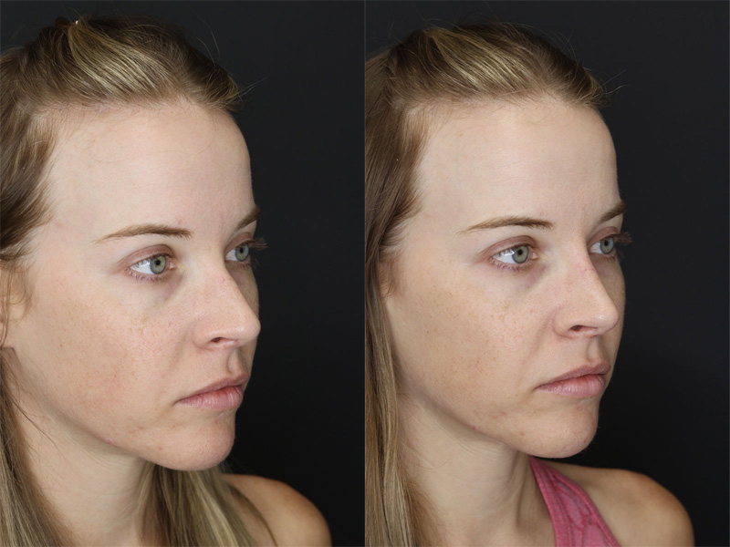 Before and After Plastic Surgery Results | Raggio MD Birmingham, Al
