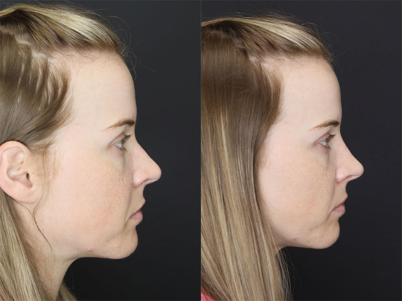 Before and After Plastic Surgery Results | Raggio MD Birmingham, Al