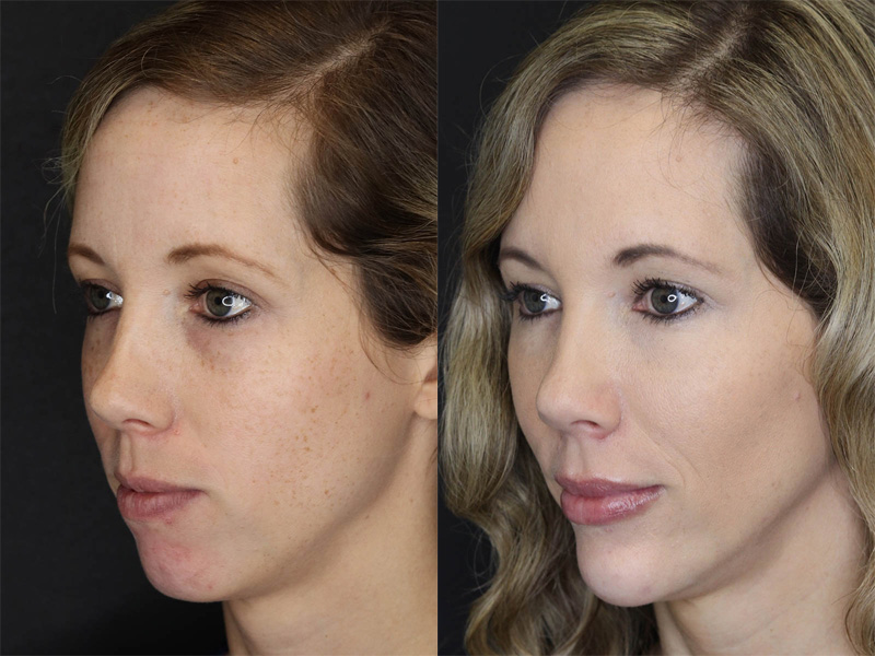 Before and After Plastic Surgery Results | Raggio MD Birmingham, Al
