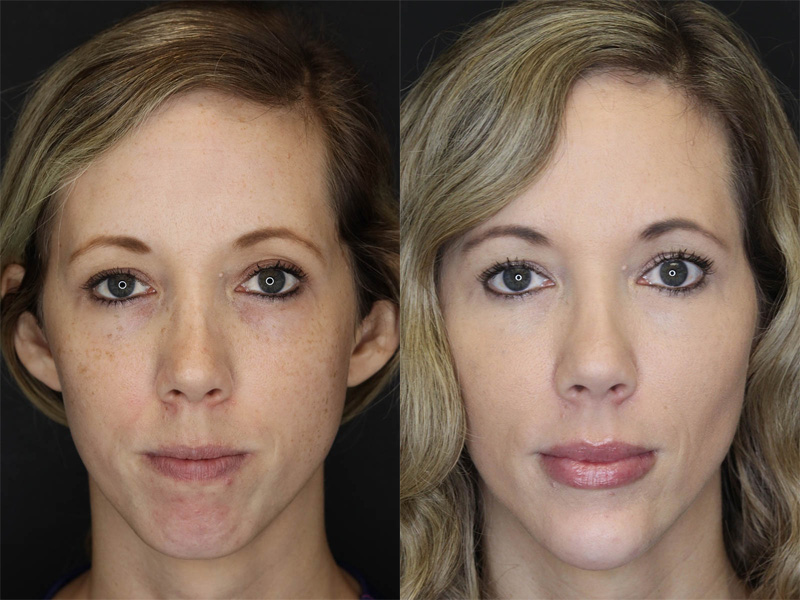 Before and After Plastic Surgery Results | Raggio MD Birmingham, Al