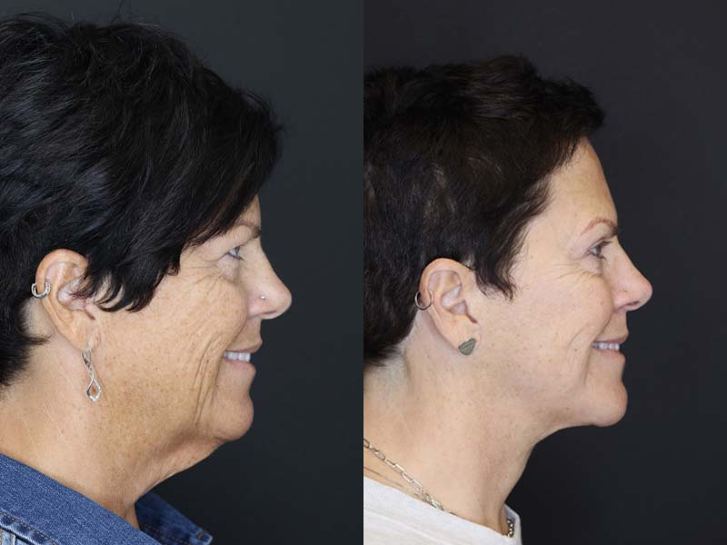 Before and After Plastic Surgery Results | Raggio MD Birmingham, Al