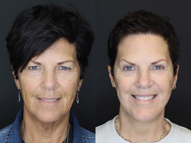 Before and After Plastic Surgery Results | Raggio MD Birmingham, Al