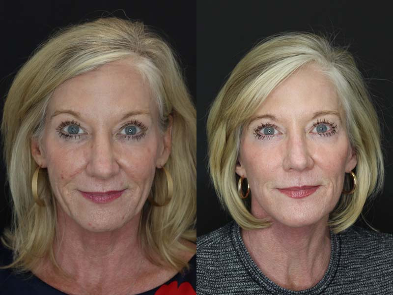 Before and After Plastic Surgery Results | Raggio MD Birmingham, Al