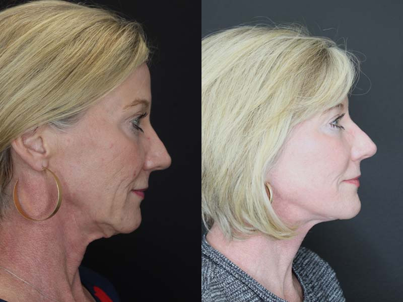 Before and After Plastic Surgery Results | Raggio MD Birmingham, Al