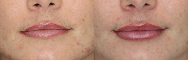 Before and After Plastic Surgery Results | Raggio MD Birmingham, Al