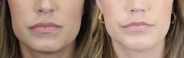Before and After Plastic Surgery Results | Raggio MD Birmingham, Al