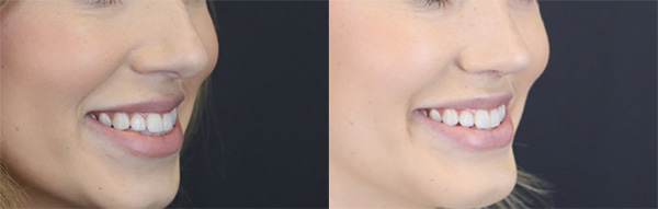 Before and After Plastic Surgery Results | Raggio MD Birmingham, Al
