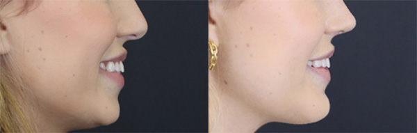 Before and After Plastic Surgery Results | Raggio MD Birmingham, Al