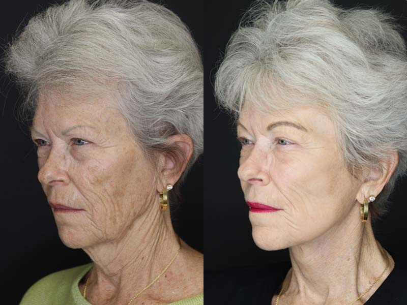 Before and After Plastic Surgery Results | Raggio MD Birmingham, Al