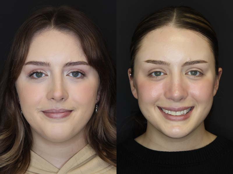 Before and After Plastic Surgery Results | Raggio MD Birmingham, Al