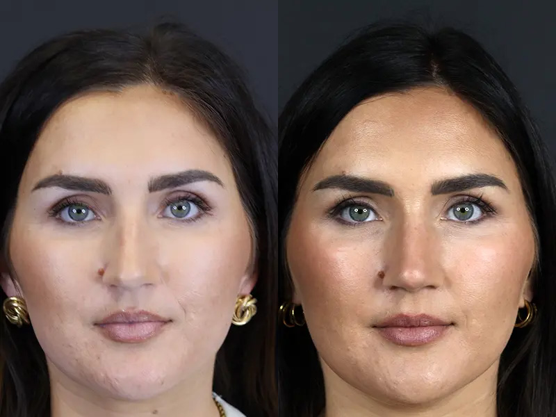 Before and After Plastic Surgery Results | Raggio MD Birmingham, Al