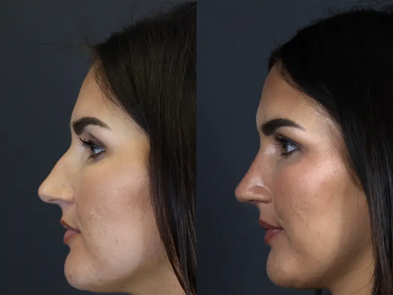 Before and After Plastic Surgery Results | Raggio MD Birmingham, Al