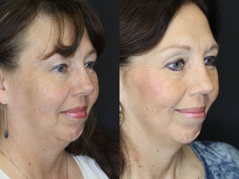 Before and After Plastic Surgery Results | Raggio MD Birmingham, Al