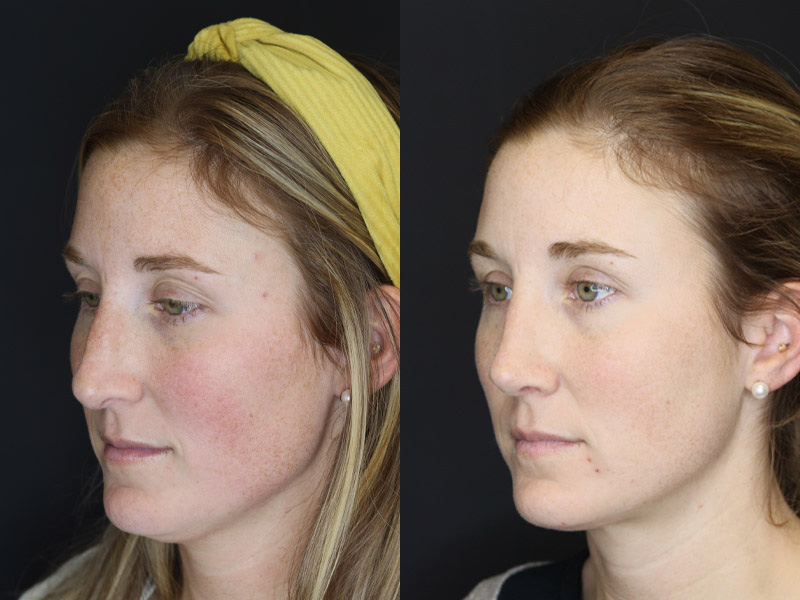 Before and After Plastic Surgery Results | Raggio MD Birmingham, Al