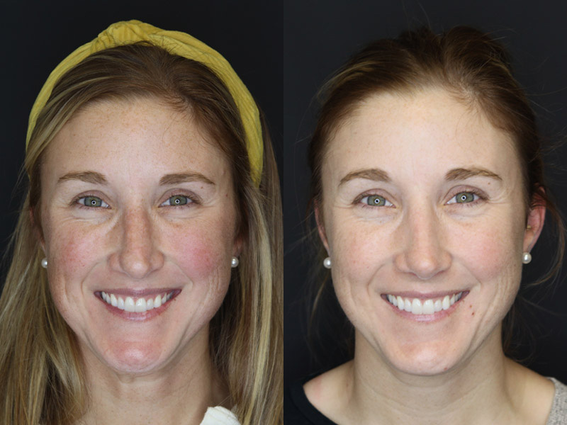 Before and After Plastic Surgery Results | Raggio MD Birmingham, Al