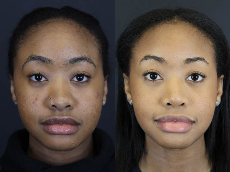 Before and After Plastic Surgery Results | Raggio MD Birmingham, Al