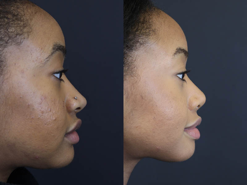 Before and After Plastic Surgery Results | Raggio MD Birmingham, Al