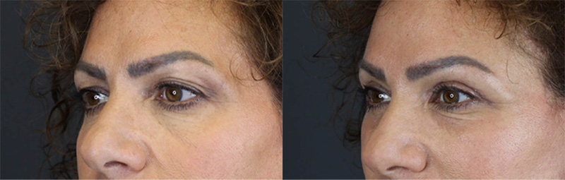 Before and After Plastic Surgery Results | Raggio MD Birmingham, Al