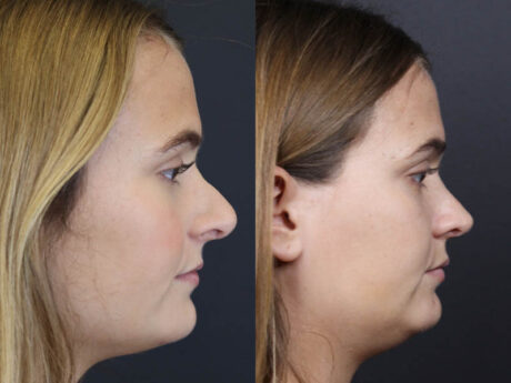 Revision Rhinoplasty case #10805