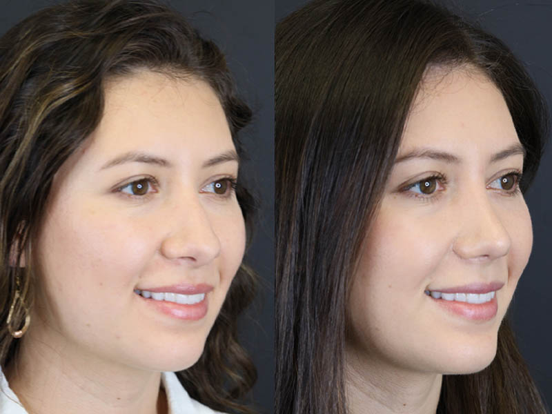 Chin Augmentation case #10308
