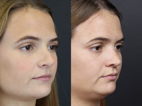 Revision Rhinoplasty case #10805
