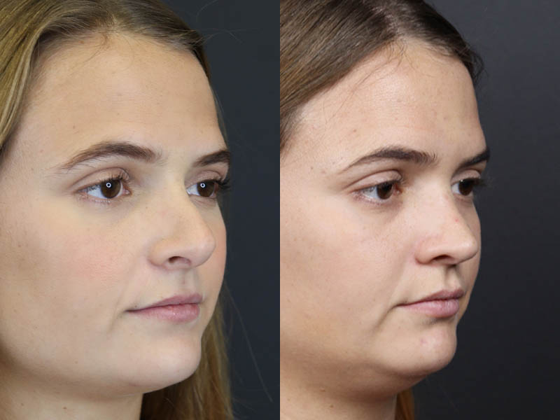 Revision Rhinoplasty case #10805
