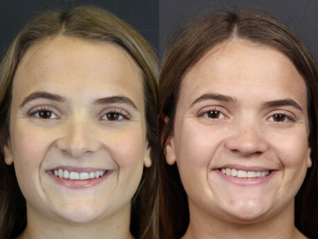 Revision Rhinoplasty case #10805
