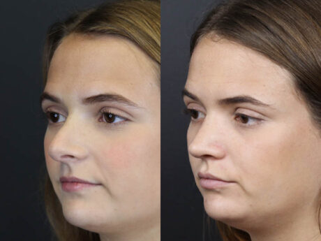 Revision Rhinoplasty case #10805