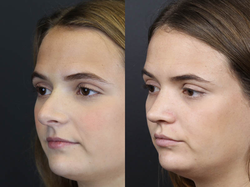 Revision Rhinoplasty case #10805