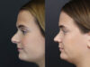 Revision Rhinoplasty case #10805 slider thumbnail