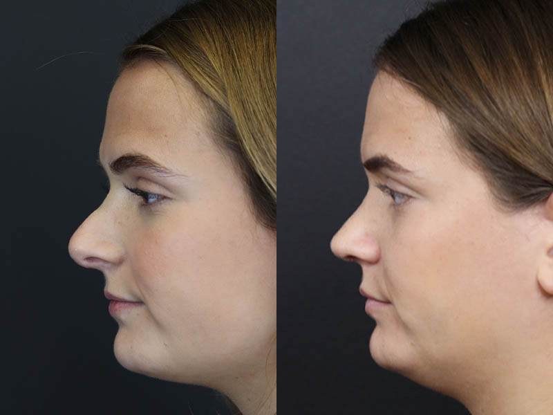 Revision Rhinoplasty case #10805