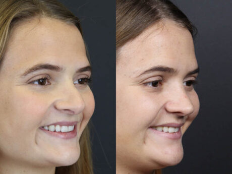 Revision Rhinoplasty case #10805