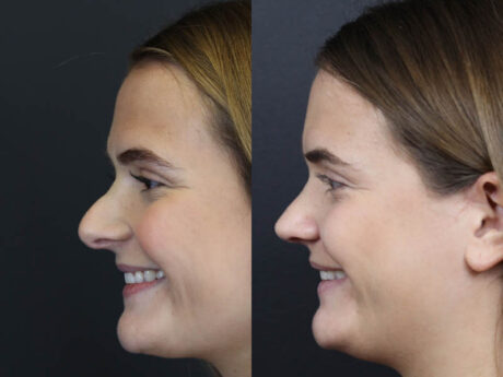 Revision Rhinoplasty case #10805