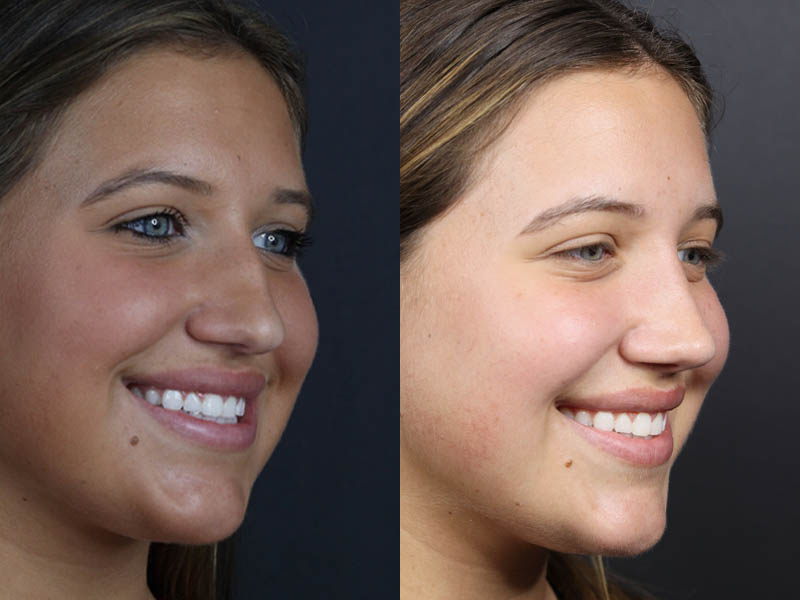 Rhinoplasty case #10814