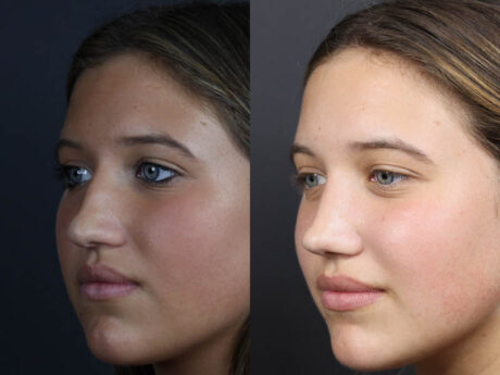 Rhinoplasty case #10814