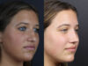 Rhinoplasty case #10814 slider thumbnail