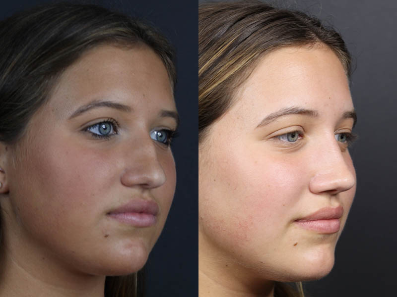 Rhinoplasty case #10814