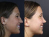 Rhinoplasty case #10814 slider thumbnail