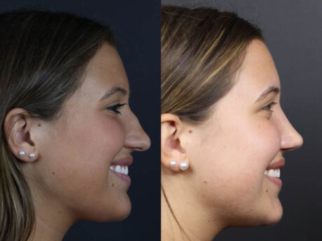 Rhinoplasty case #10814