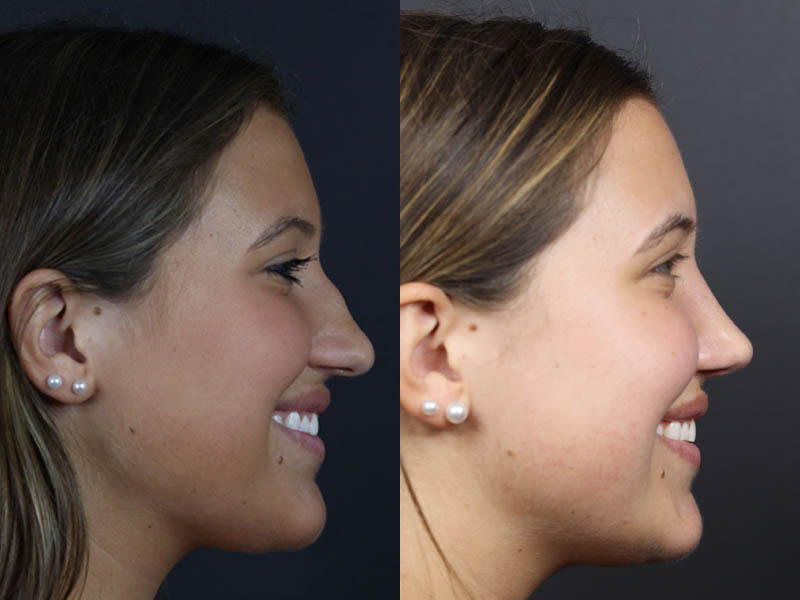 Rhinoplasty case #10814