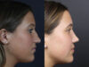 Rhinoplasty case #10814 slider thumbnail