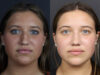 Rhinoplasty case #10814 slider thumbnail