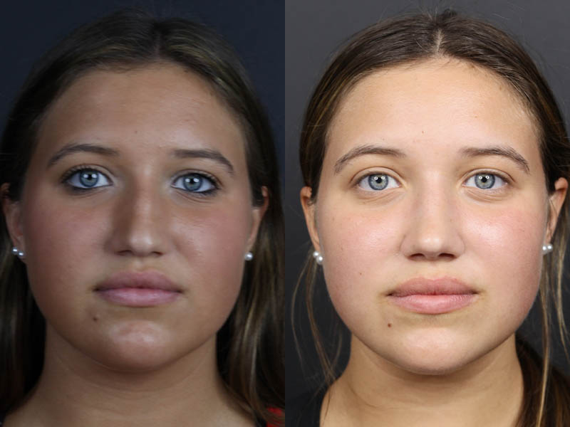 Rhinoplasty case #10814