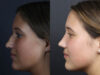 Rhinoplasty case #10814 slider thumbnail