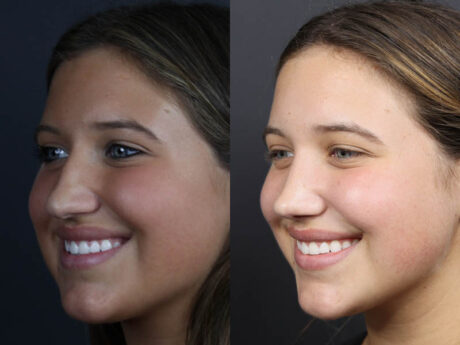 Rhinoplasty case #10814