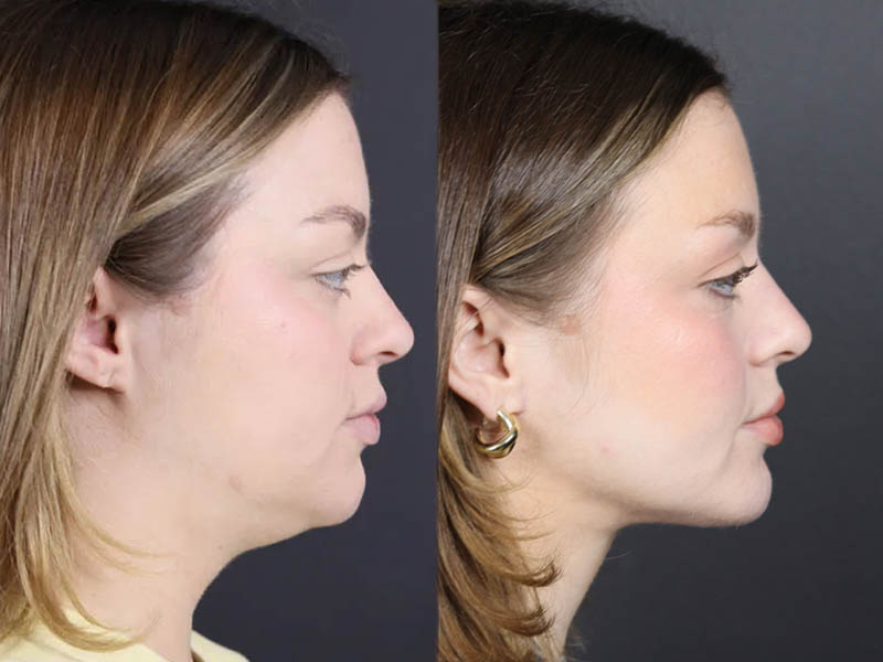 Necklift case #11064