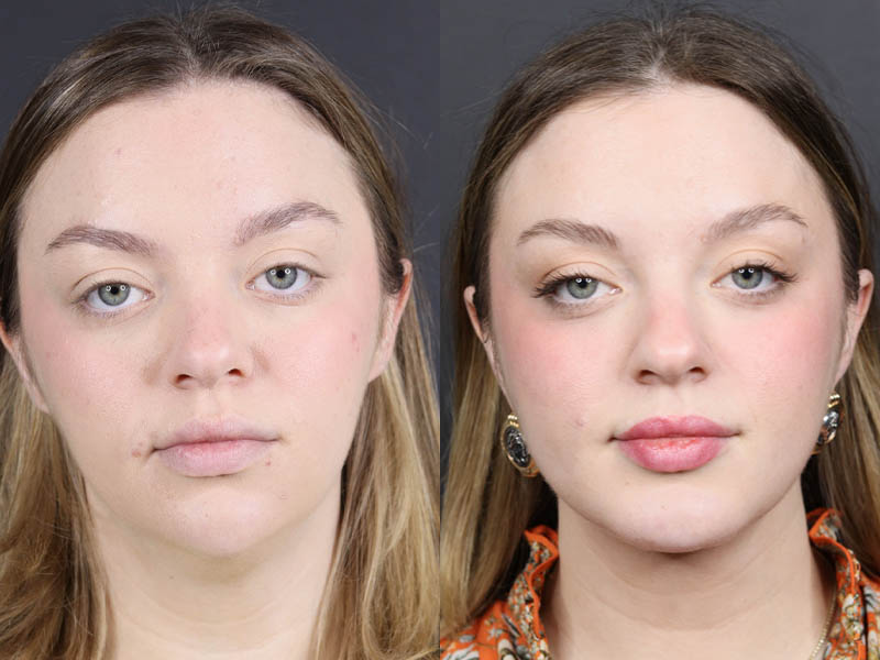 Necklift case #11064