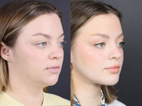 Necklift case #11064