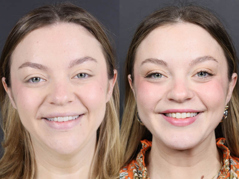 Necklift case #11064